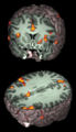 MRI of brain